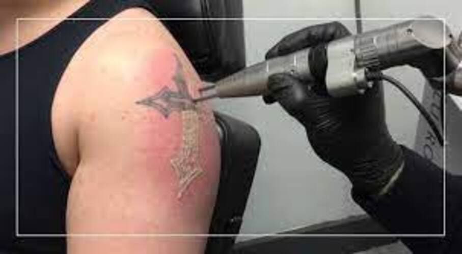 Harshaskincare-Laser-Tattoo-Removal-img